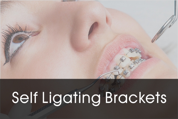 self ligating brackets