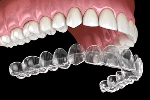 invisalign