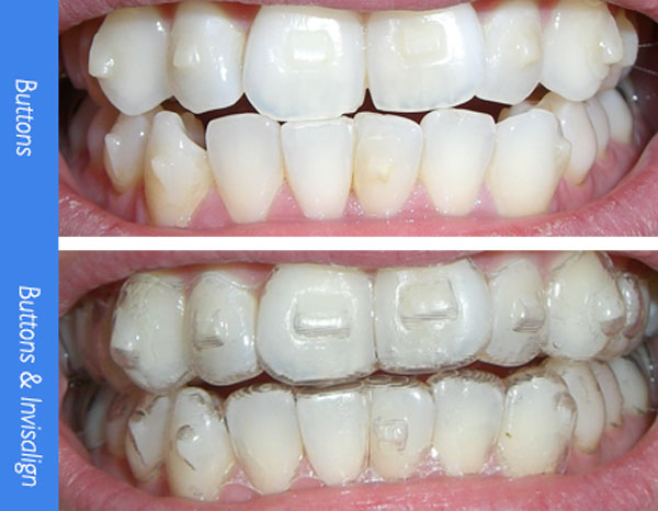 invisalign