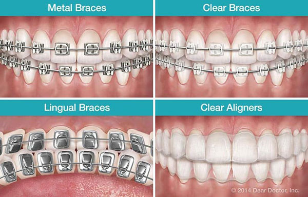 lingual-braces
